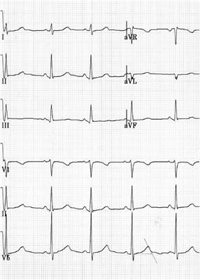 Coexistence of Two Rare Genetic Variants in Canonical and Non-canonical Exons of SCN5A: A Potential Source of Misinterpretation